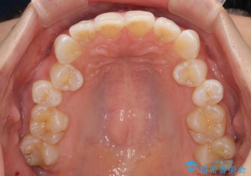 デコボコの非抜歯矯正 ワイヤー装置で楽して改善の治療前