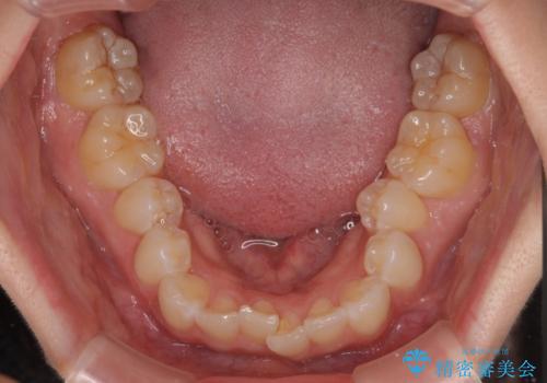 デコボコの非抜歯矯正 ワイヤー装置で楽して改善の治療前