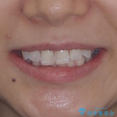 デコボコの非抜歯矯正 ワイヤー装置で楽して改善の治療前(顔貌)