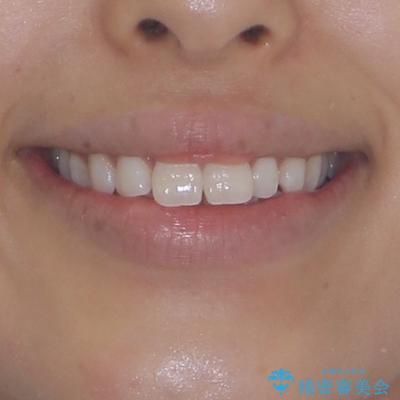 斜め前に飛び出した前歯 抜歯矯正で素敵な横顔にの治療前(顔貌)