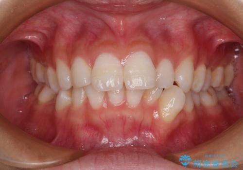 斜め前に飛び出した前歯 抜歯矯正で素敵な横顔にの治療前