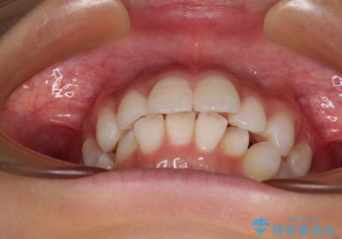 斜め前に飛び出した前歯 抜歯矯正で素敵な横顔にの治療前