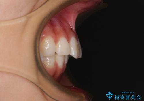 斜め前に飛び出した前歯 抜歯矯正で素敵な横顔にの症例 治療前