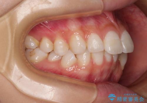 斜め前に飛び出した前歯 抜歯矯正で素敵な横顔にの治療前