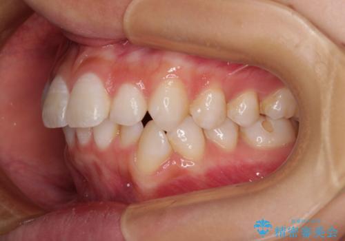 斜め前に飛び出した前歯 抜歯矯正で素敵な横顔にの治療前