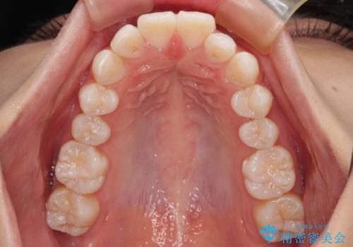 斜め前に飛び出した前歯 抜歯矯正で素敵な横顔にの治療前