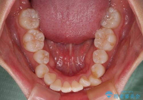 斜め前に飛び出した前歯 抜歯矯正で素敵な横顔にの治療前