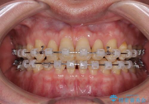 【モニター】ディープバイトで隙間の空いた歯列 ワイヤー装置での非抜歯矯正の治療中