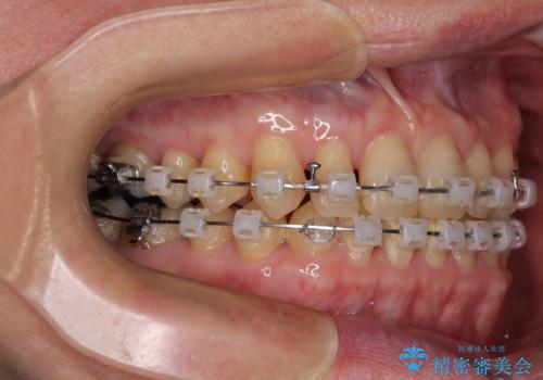 【モニター】ディープバイトで隙間の空いた歯列 ワイヤー装置での非抜歯矯正の治療中