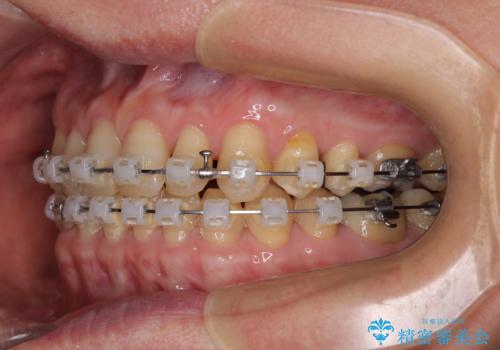 【モニター】ディープバイトで隙間の空いた歯列 ワイヤー装置での非抜歯矯正の治療中