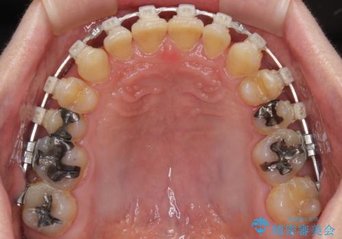 【モニター】ディープバイトで隙間の空いた歯列 ワイヤー装置での非抜歯矯正の治療中
