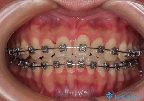 急速拡大装置 狭い歯列を拡大してクロスバイトを短期間矯正治療の治療中