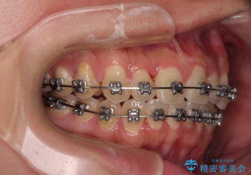 急速拡大装置 狭い歯列を拡大してクロスバイトを短期間矯正治療の治療中