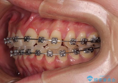 急速拡大装置 狭い歯列を拡大してクロスバイトを短期間矯正治療の治療中