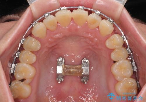 急速拡大装置 狭い歯列を拡大してクロスバイトを短期間矯正治療の治療中