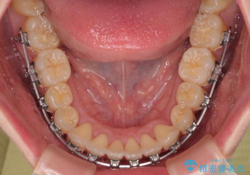 急速拡大装置 狭い歯列を拡大してクロスバイトを短期間矯正治療の治療中