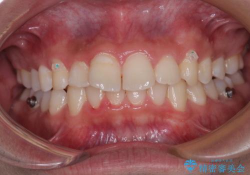 デコボコをインビザライン矯正で改善 奥歯は補助装置で確実に移動をの治療中
