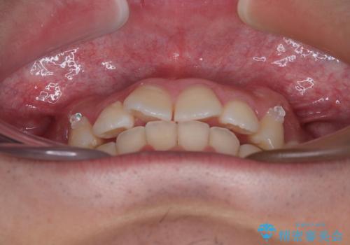 デコボコをインビザライン矯正で改善 奥歯は補助装置で確実に移動をの治療中