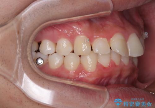 デコボコをインビザライン矯正で改善 奥歯は補助装置で確実に移動をの治療中