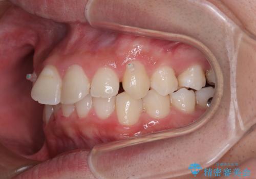 デコボコをインビザライン矯正で改善 奥歯は補助装置で確実に移動をの治療中