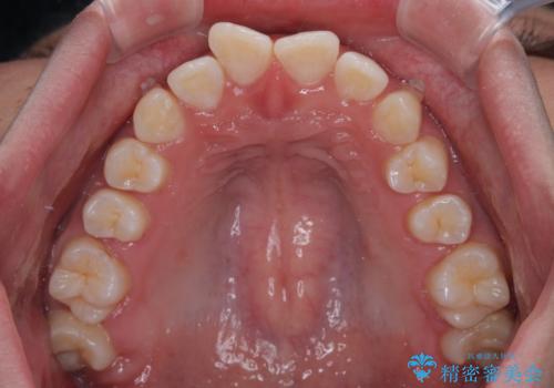 デコボコをインビザライン矯正で改善 奥歯は補助装置で確実に移動をの治療中