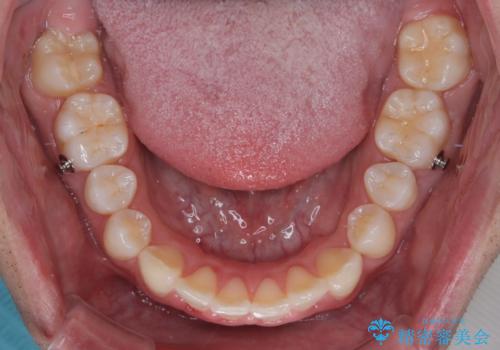 デコボコをインビザライン矯正で改善 奥歯は補助装置で確実に移動をの治療中