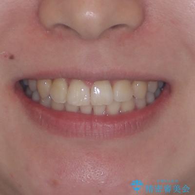 捻転の強い前歯 ワイヤー装置での非抜歯矯正の治療後(顔貌)