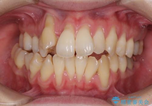 急速拡大装置 狭い骨幅を拡大した上で、顕著なデコボコを改善する抜歯矯正治療の症例 治療前