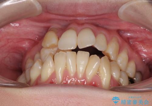 急速拡大装置 狭い骨幅を拡大した上で、顕著なデコボコを改善する抜歯矯正治療の治療前