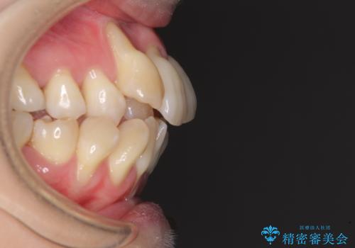 急速拡大装置 狭い骨幅を拡大した上で、顕著なデコボコを改善する抜歯矯正治療の治療前