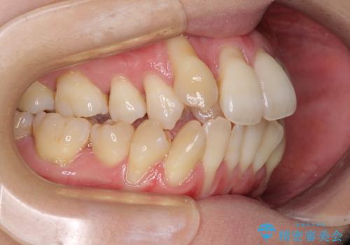急速拡大装置 狭い骨幅を拡大した上で、顕著なデコボコを改善する抜歯矯正治療の治療前