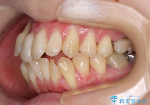 急速拡大装置 狭い骨幅を拡大した上で、顕著なデコボコを改善する抜歯矯正治療の治療前