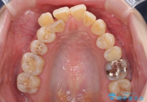 急速拡大装置 狭い骨幅を拡大した上で、顕著なデコボコを改善する抜歯矯正治療の治療前