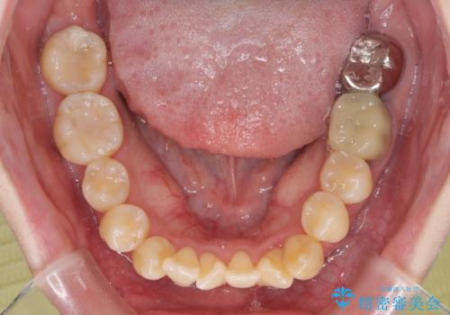急速拡大装置 狭い骨幅を拡大した上で、顕著なデコボコを改善する抜歯矯正治療の治療前