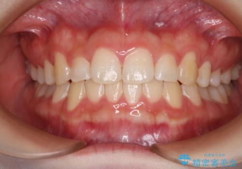 前歯のガタつきを治したい　インビザライン・ライトパッケージの症例 治療後