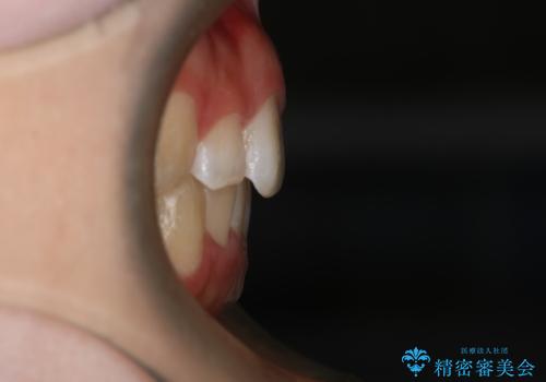 前歯のガタつきを治したい　インビザライン・ライトパッケージの治療後