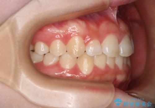 前歯のガタつきを治したい インビザライン・ライトパッケージの治療後