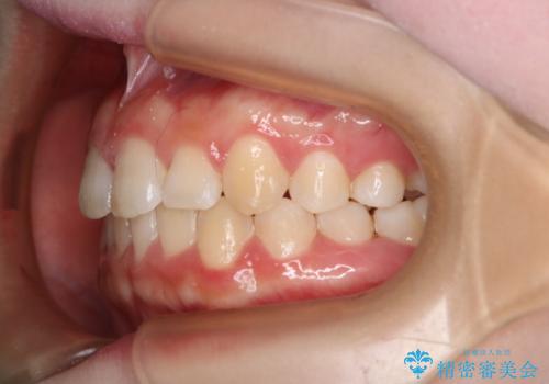 前歯のガタつきを治したい　インビザライン・ライトパッケージの治療後