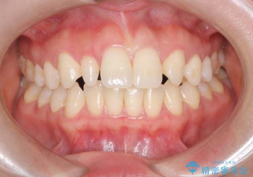 軽度の歯のデコボコ(叢生)をインビザライン(マウスピース)で改善|わずか5か月で整った歯並びにの治療前