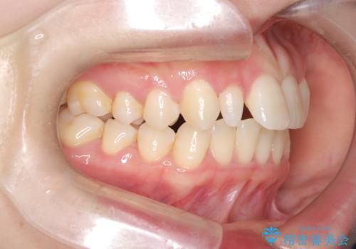 軽度の歯のデコボコ(叢生)をインビザライン(マウスピース)で改善|わずか5か月で整った歯並びにの治療前