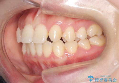 軽度の歯のデコボコ(叢生)をインビザライン(マウスピース)で改善|わずか5か月で整った歯並びにの治療前