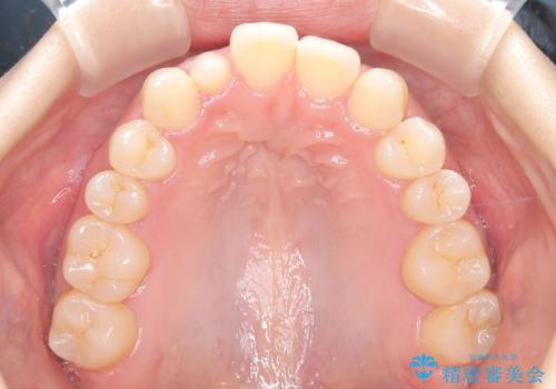 軽度の歯のデコボコ(叢生)をインビザライン(マウスピース)で改善|わずか5か月で整った歯並びにの治療前