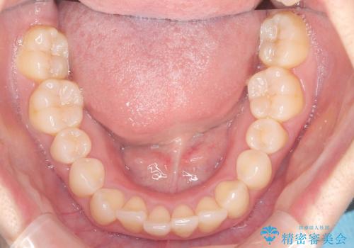軽度の歯のデコボコ(叢生)をインビザライン(マウスピース)で改善|わずか5か月で整った歯並びにの症例 治療前