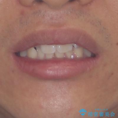 前歯のデコボコをインビザラインで綺麗に改善の治療前(顔貌)