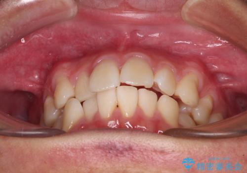 前歯のデコボコをインビザラインで綺麗に改善の治療前