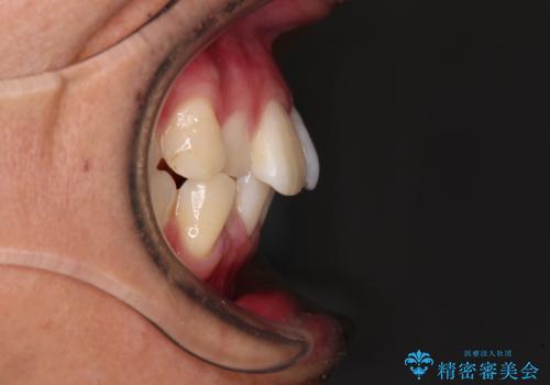 前歯のデコボコをインビザラインで綺麗に改善の治療前