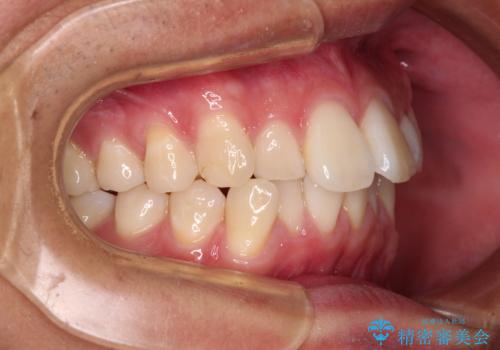 前歯のデコボコをインビザラインで綺麗に改善の治療前