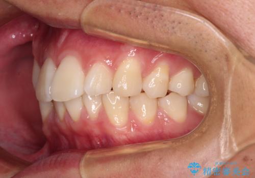 前歯のデコボコをインビザラインで綺麗に改善の治療前