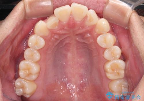 前歯のデコボコをインビザラインで綺麗に改善の治療前