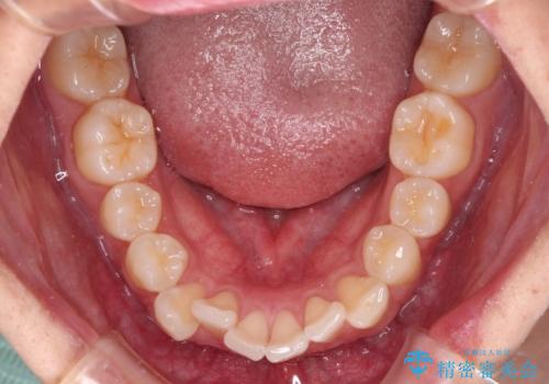 前歯のデコボコをインビザラインで綺麗に改善の治療前